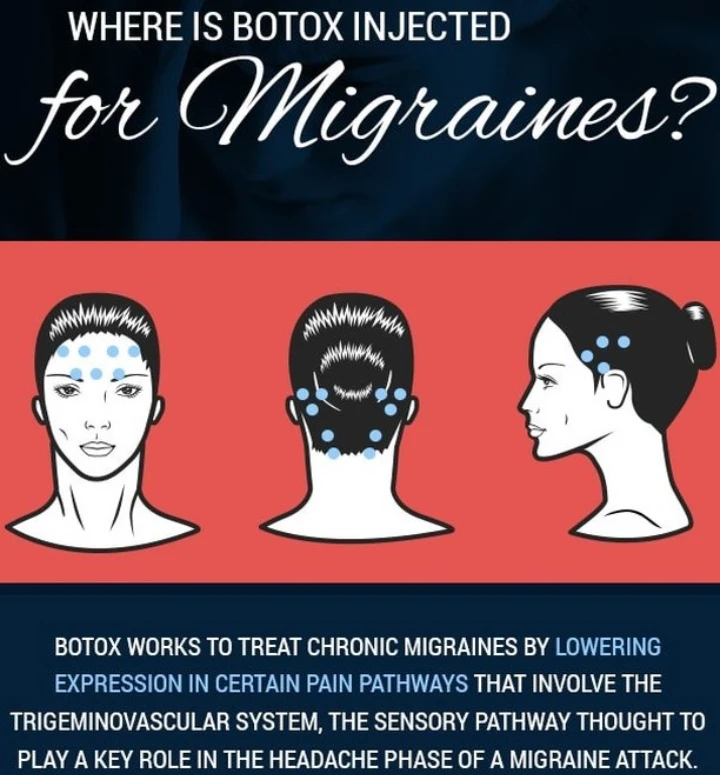 Botox for Migraines Side Effects