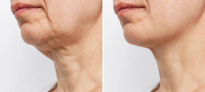 Botox for Neck Sagging Before and After