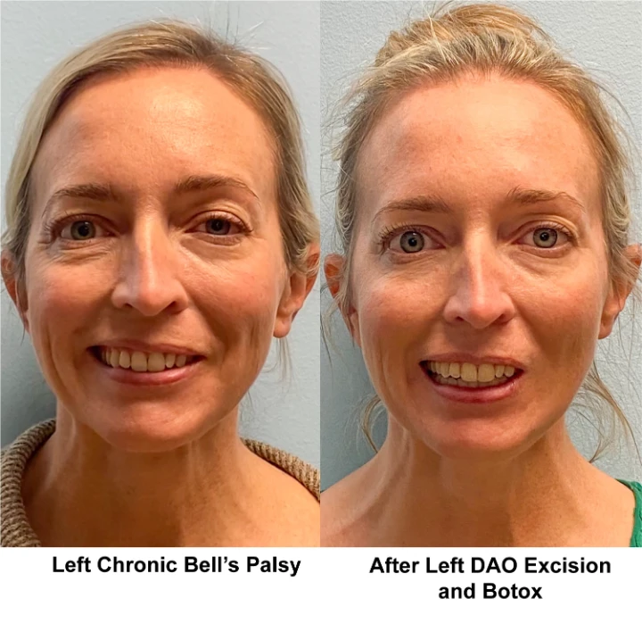 DAO Botox Before and After