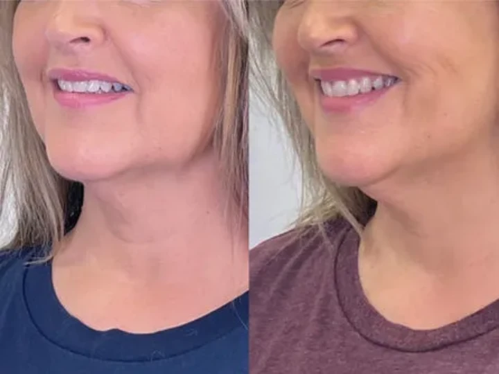 DAO Botox Before and After