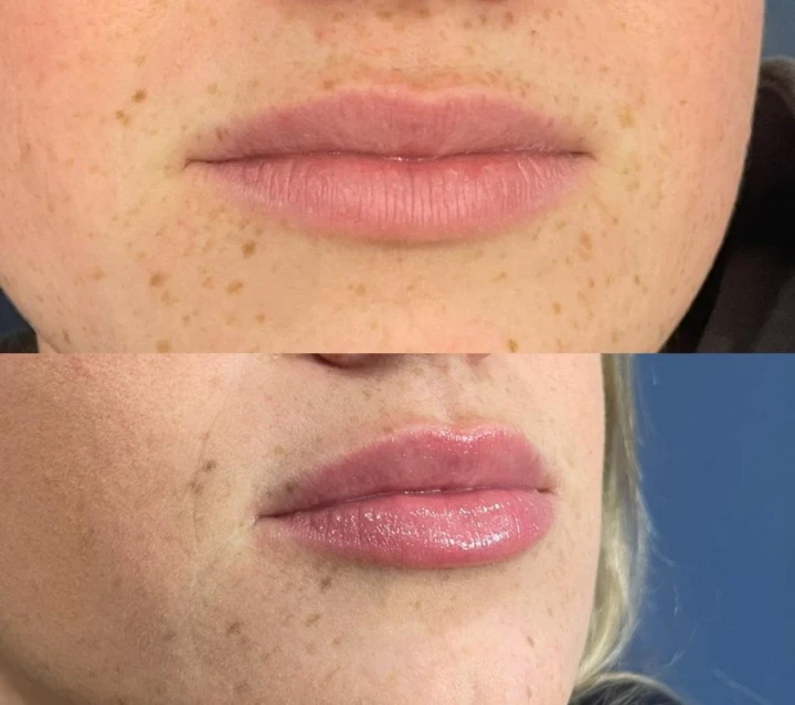 Daxxify Lip Flip Before and After