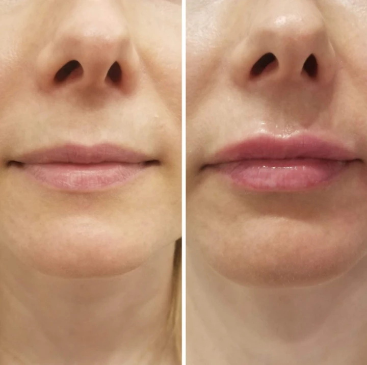 Daxxify Lip flip before and after