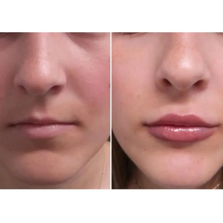 Daxxify Lip flip before and after