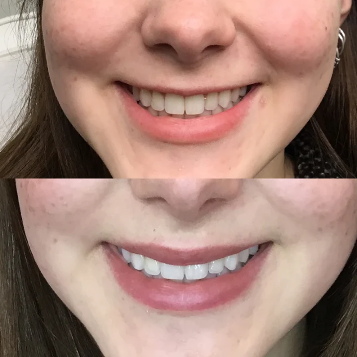 Daxxify Lip flip before and after