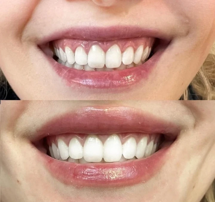 Daxxify Lip flip before and after