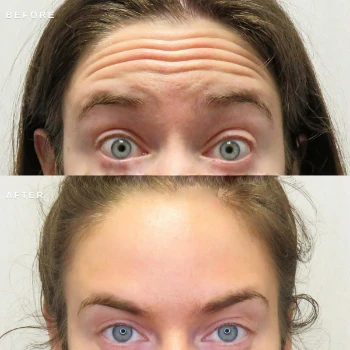 Deep Forehead Wrinkles Botox Before and After