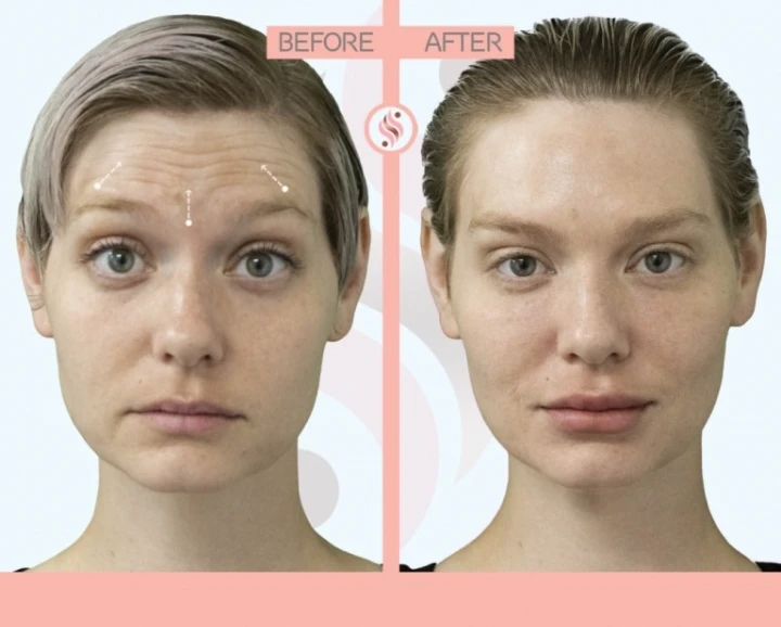 Dysport vs Botox Pictures