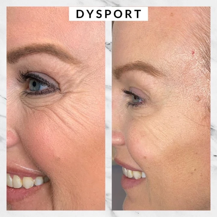 Dysport vs Botox Pictures