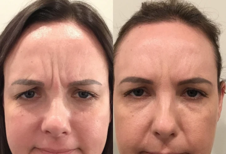 Dysport vs Botox Pictures