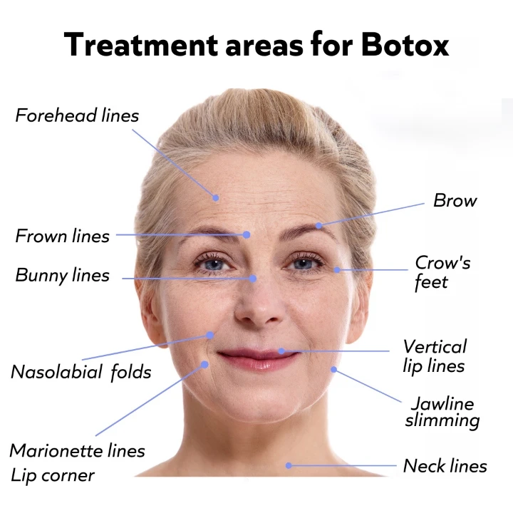 Facial Diagram Botox Injection Sites