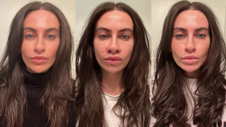 Gone wrong Botox upper lip flip before and after