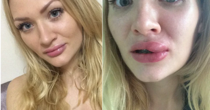 Gone wrong Botox upper lip flip before and after