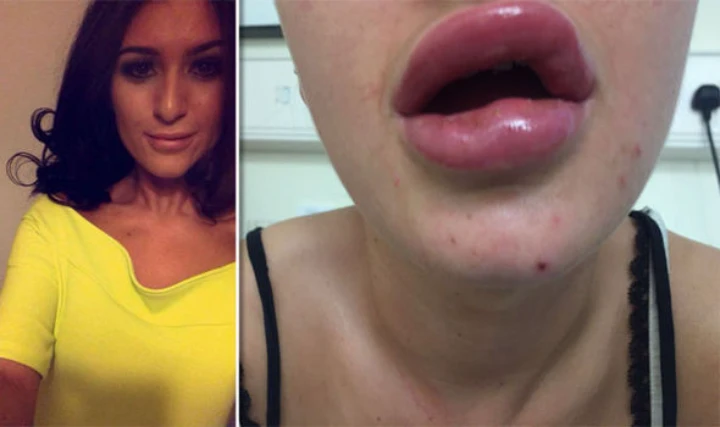 Gone wrong Botox upper lip flip before and after