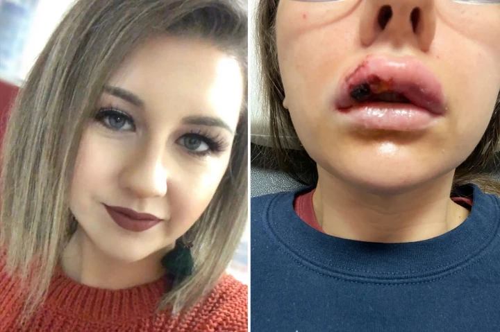 Gone wrong Botox upper lip flip before and after