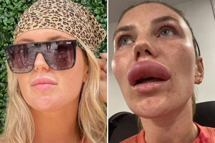 Gone wrong Botox upper lip flip before and after