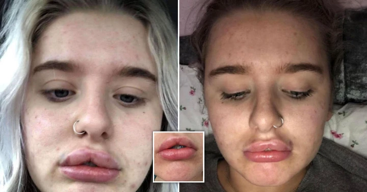 Gone wrong Botox upper lip flip before and after