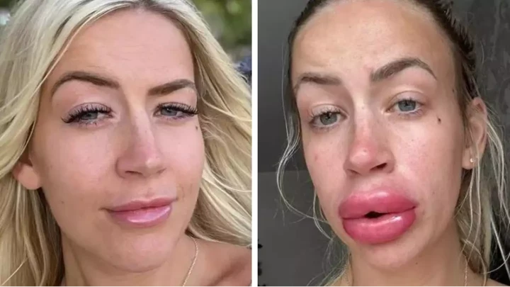 Gone wrong Botox upper lip flip before and after