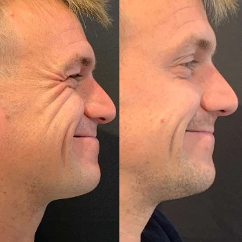 Male Botox Before and After