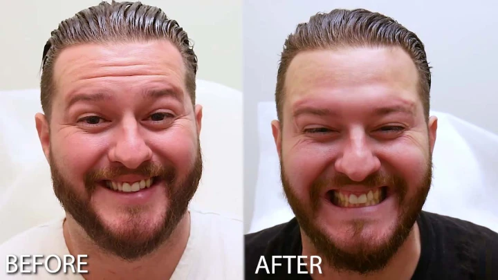 Male Botox Forehead Before and After