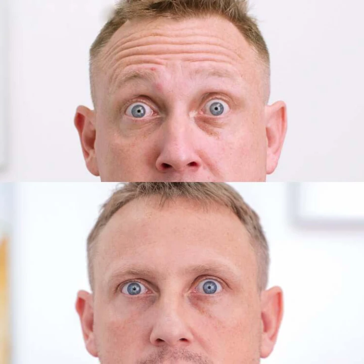 Male Botox Before and After