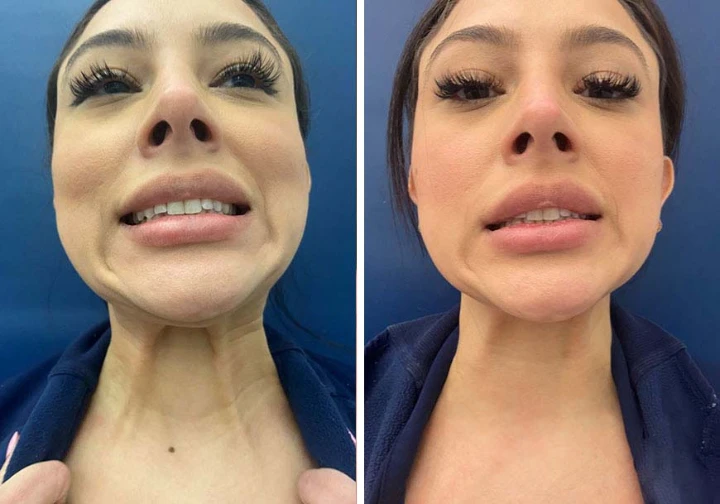 Neck Botox Before and After