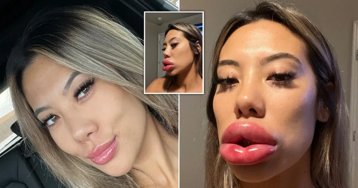 Smile Gone Wrong Botox Upper Lip Flip Before and After