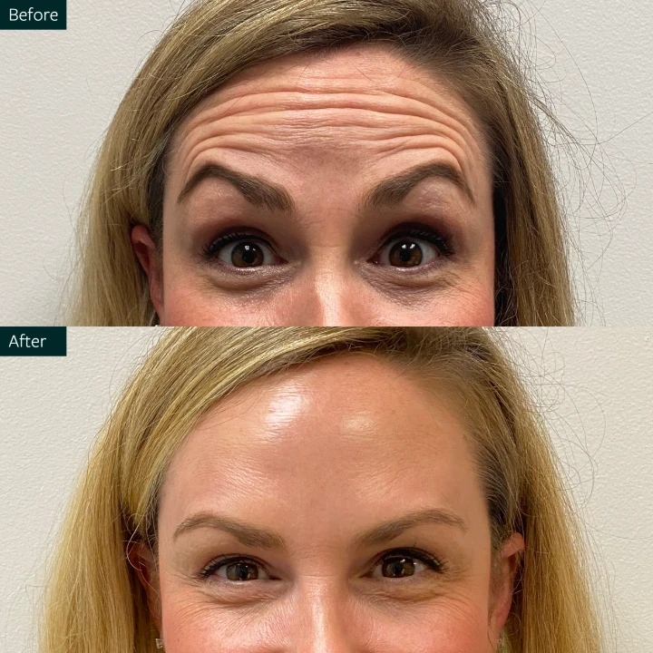 Deep Forehead Wrinkles Botox Before and After