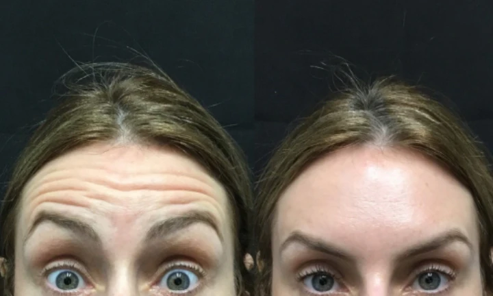 Deep Forehead Wrinkles Botox Before and After