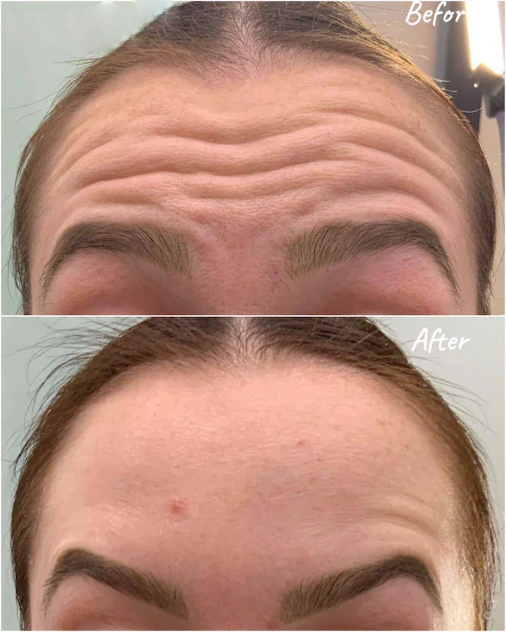 Deep Forehead Wrinkles Botox Before and After