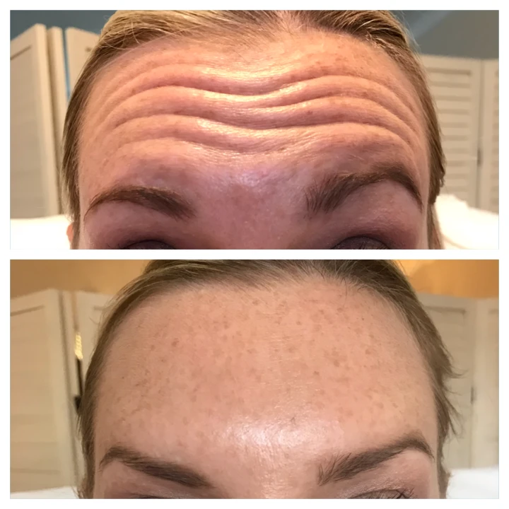 Deep Forehead Wrinkles Botox Before and After