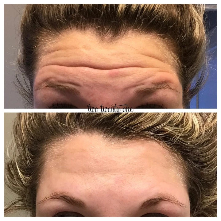 Deep Forehead Wrinkles Botox Before and After