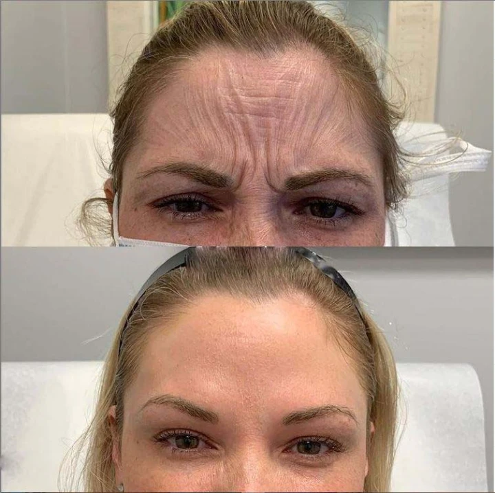 Deep Forehead Wrinkles Botox Before and After