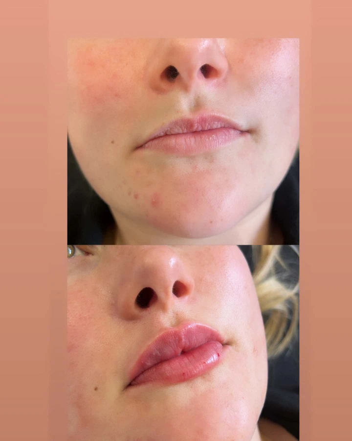 Lip Flip Before and After