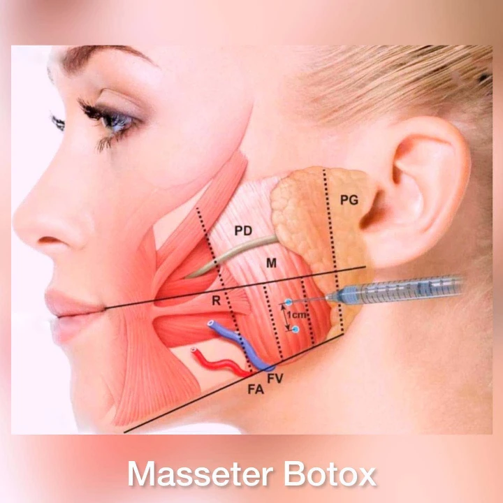 Masseter Botox Cost